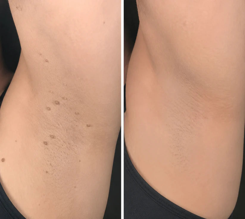 ✨ShapeOil®2-in-1 Microneedle & Hydrocolloid Patch🍀| Removes Raised Moles, Acne, Flat Warts & Skin Tags | Helps Improve Wrinkles, Scars & Blemishes | Invisible Patches for Face & Body