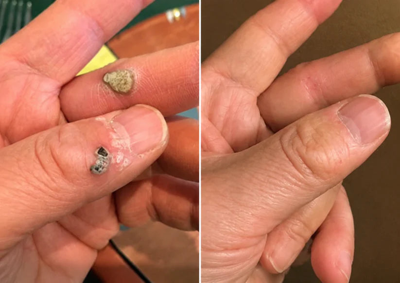 ✨ShapeOil®2-in-1 Microneedle & Hydrocolloid Patch🍀| Removes Raised Moles, Acne, Flat Warts & Skin Tags | Helps Improve Wrinkles, Scars & Blemishes | Invisible Patches for Face & Body