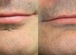 ✨ShapeOil®2-in-1 Microneedle & Hydrocolloid Patch🍀| Removes Raised Moles, Acne, Flat Warts & Skin Tags | Helps Improve Wrinkles, Scars & Blemishes | Invisible Patches for Face & Body