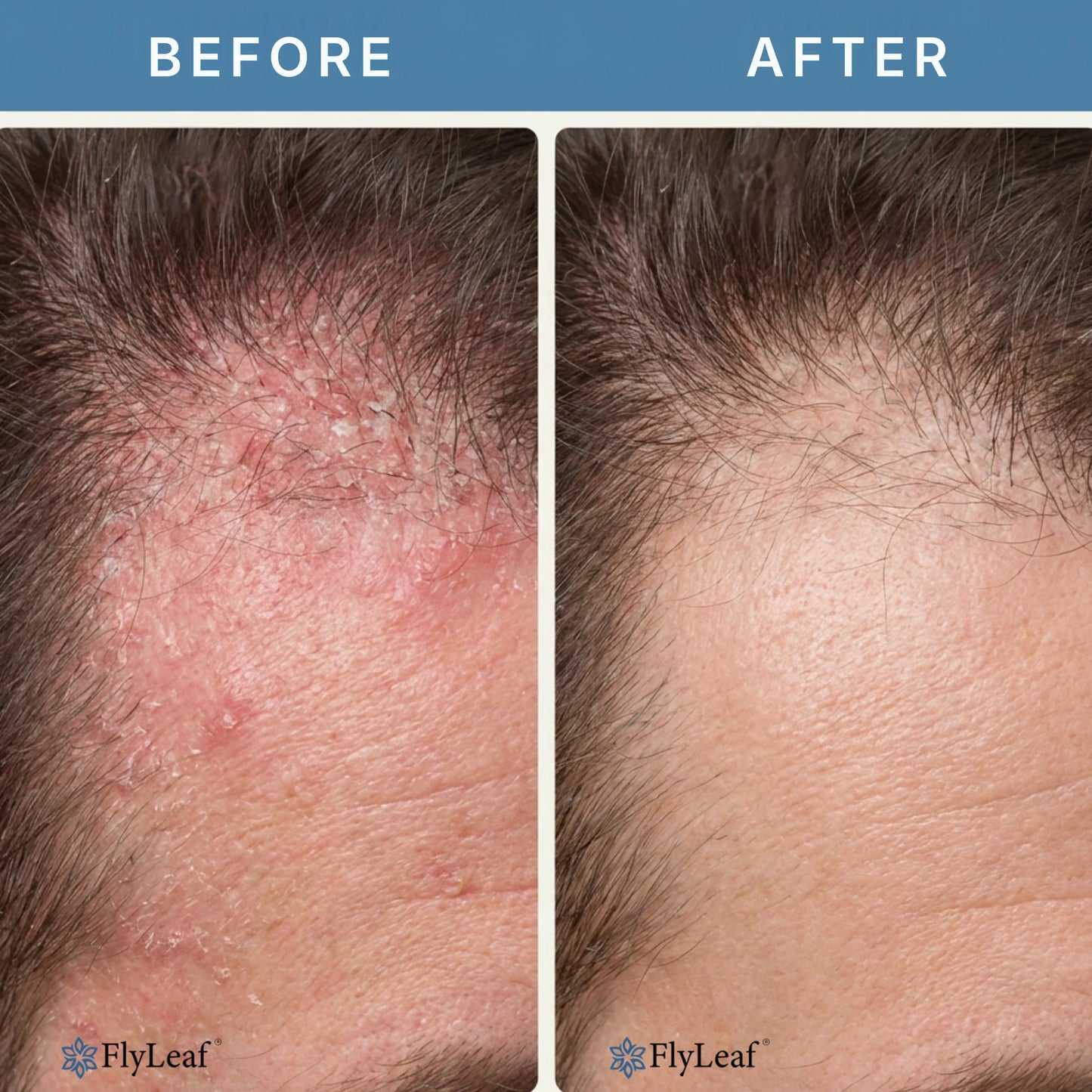 Seborrheic dermatitis and psoriasis treatment cream