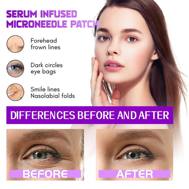 Dissolving Microneedle Eye Patches