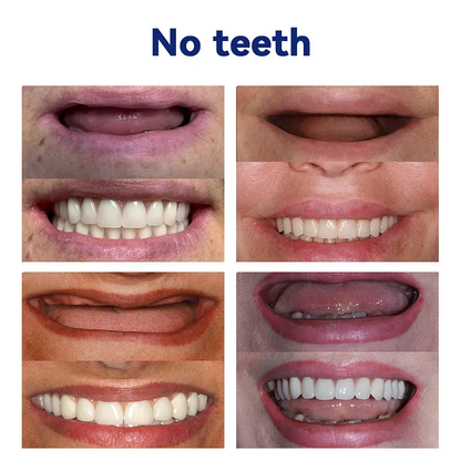 NESLEMY-🦷Advanced Customized Full Denture Set🦷